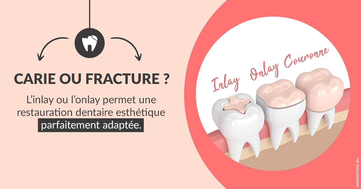 https://dr-bordes-maryse.chirurgiens-dentistes.fr/T2 2023 - Carie ou fracture 2