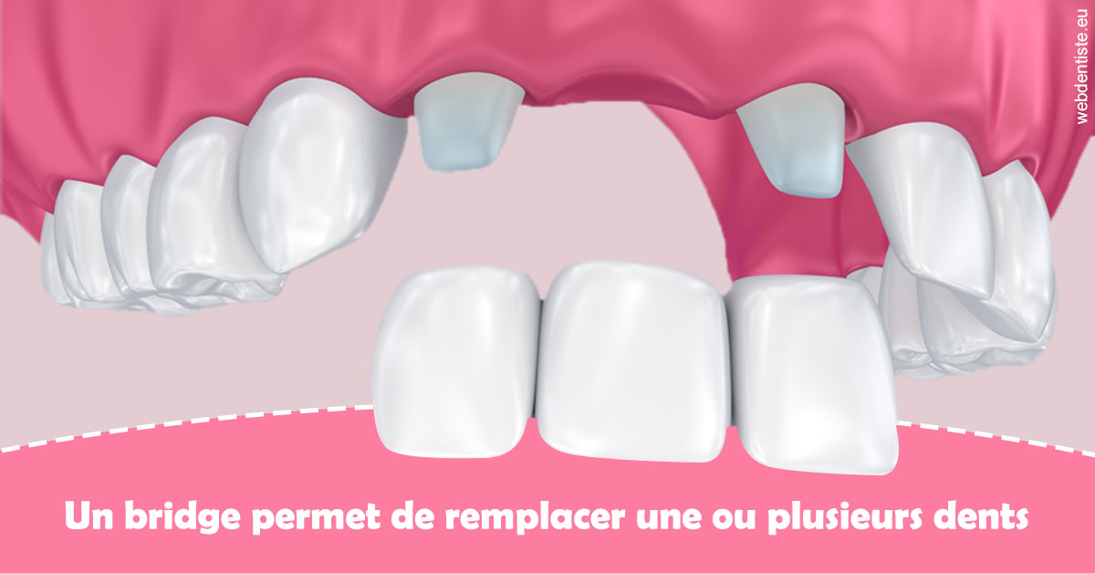 https://dr-bordes-maryse.chirurgiens-dentistes.fr/Bridge remplacer dents 2