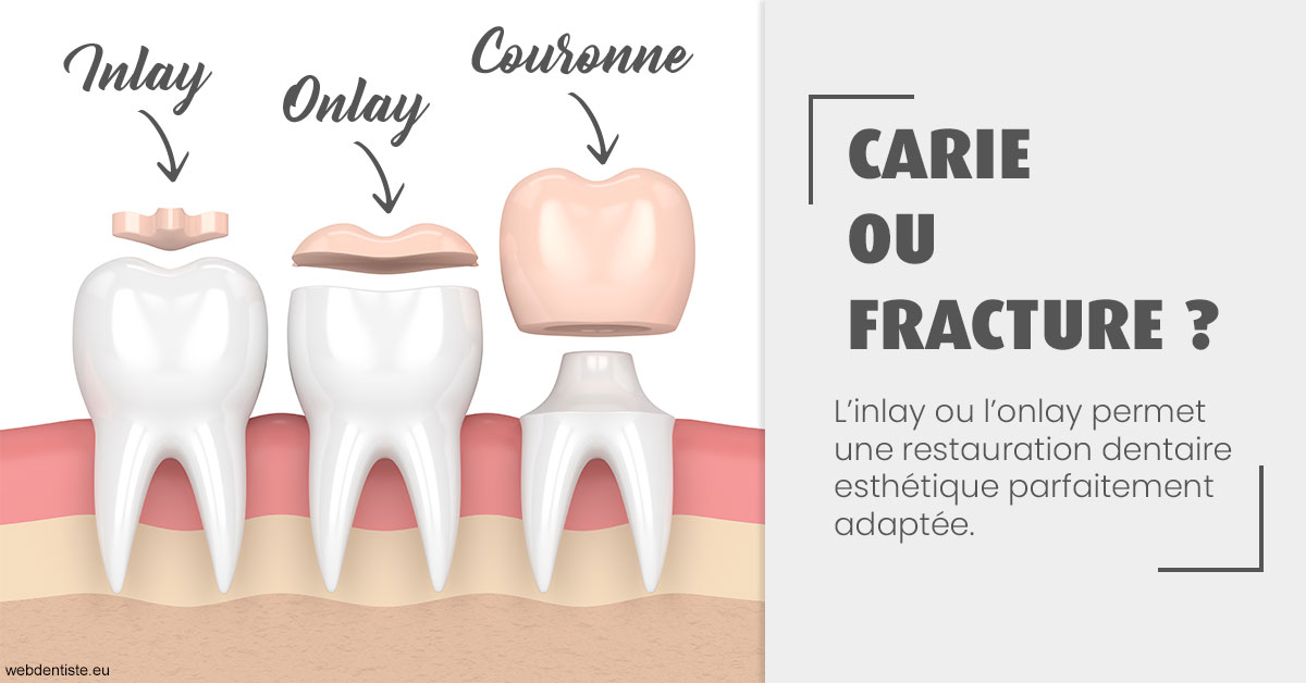 https://dr-bordes-maryse.chirurgiens-dentistes.fr/T2 2023 - Carie ou fracture 1
