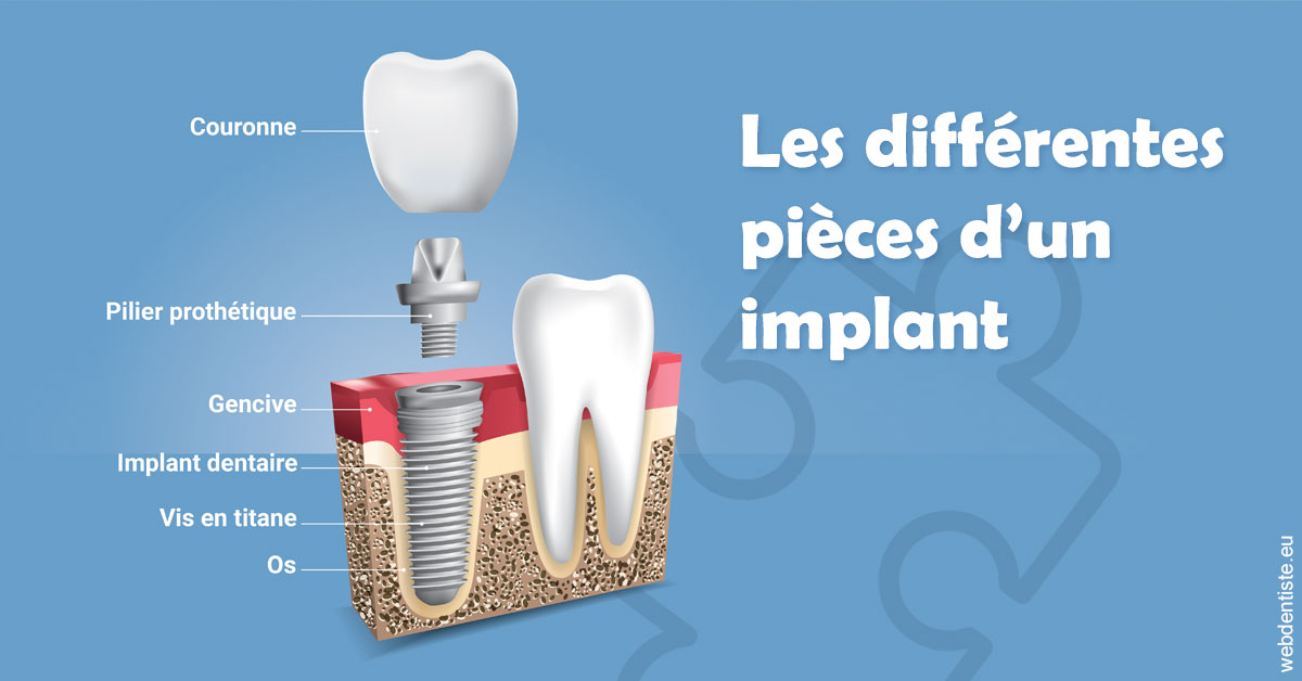 https://dr-bordes-maryse.chirurgiens-dentistes.fr/Les différentes pièces d’un implant 1
