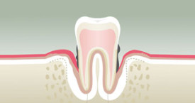 parodontologie4-275x145